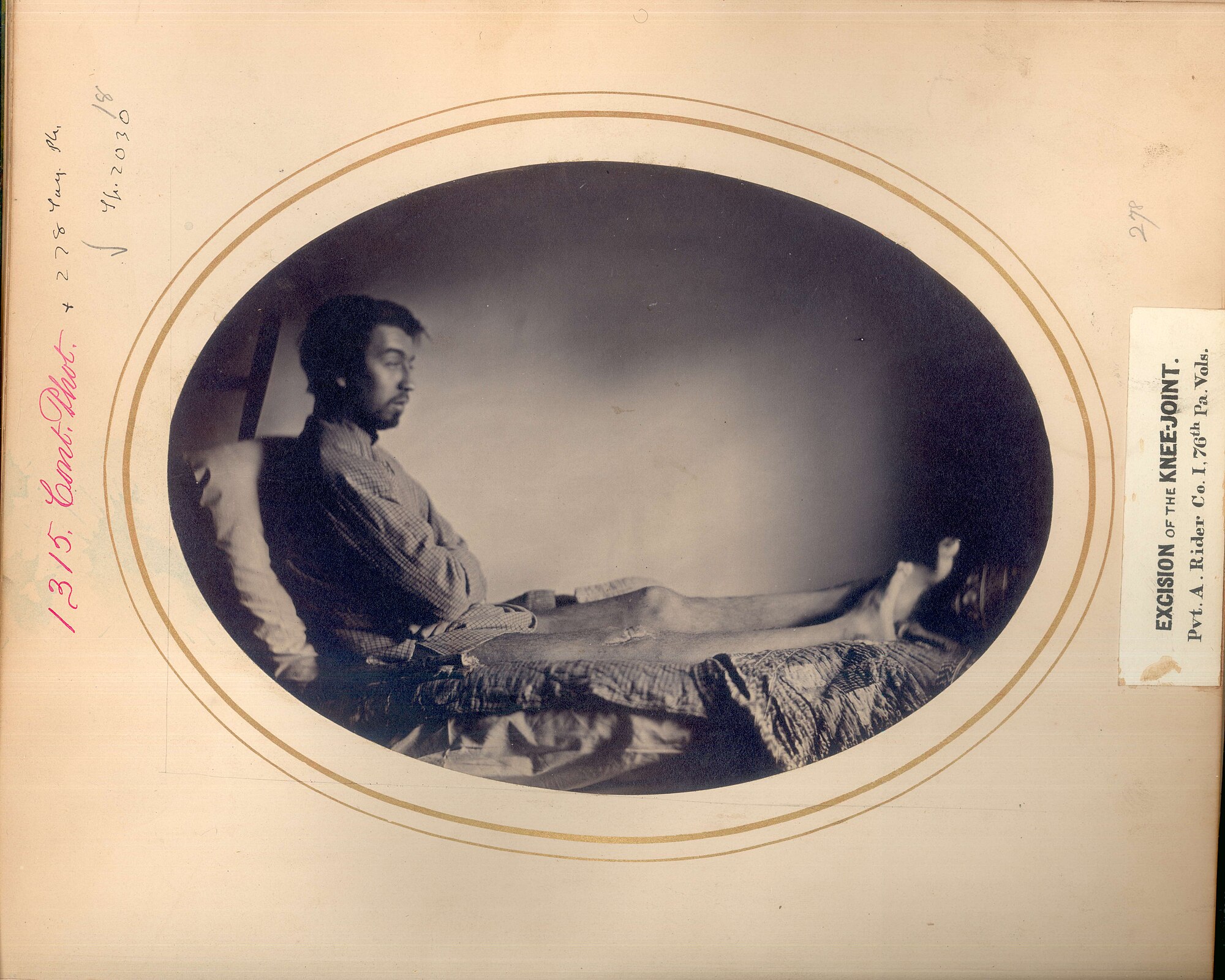 Private Alexander Rider — A Saved Leg and the Cost of War